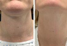 Radiofrequency (RF) Microneedling in Dubai for Advanced Complexion Renewal Radiofrequency (RF) Microneedling in Dubai for Advanced Complexion Renewal