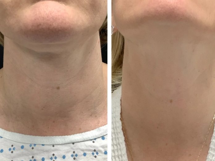Laser Treatment Radiofrequency (RF) Microneedling in Dubai for Advanced Complexion Renewal