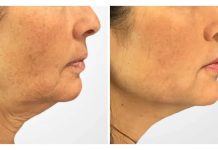 Best Doctors in Dubai for Enhanced Jawline and Facial Definition With Thread Lift